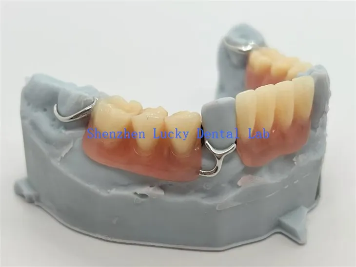 Parciales de acrílico impresos en 3D con cierre de barra en T-