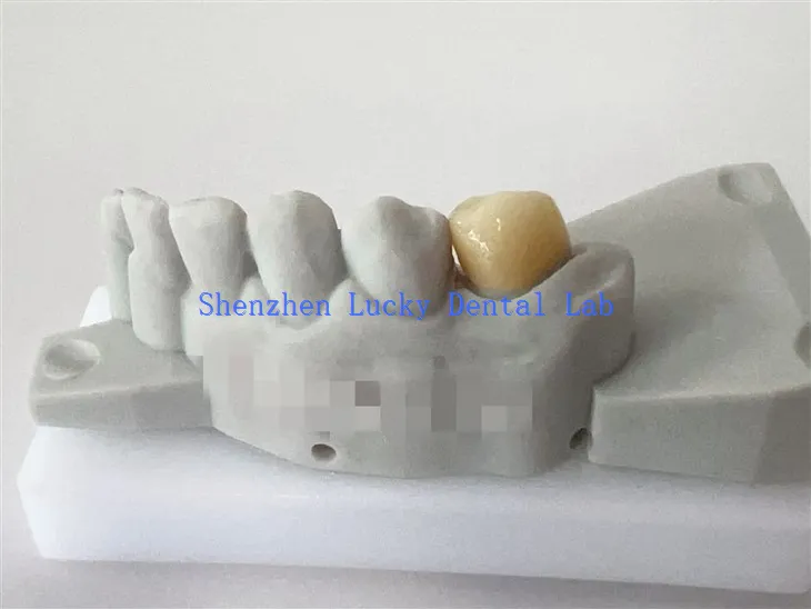 Fábrica de Crown Dental Zirconia Dental personalizada de China 3D