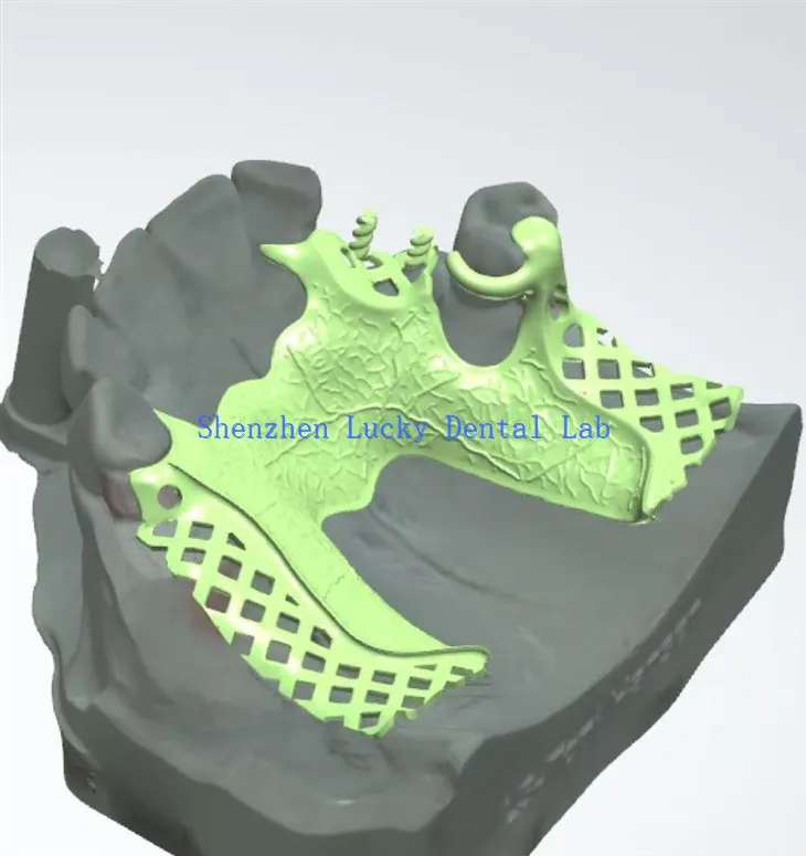 Fabricantes de marco de metal dental de impresión 3D