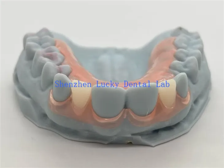Dentaduras postizas parciales flexibles Dental TCS con impresión 3D