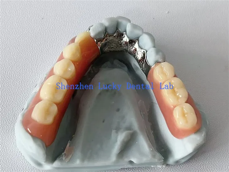 Marco de metal dental de placa lingual de impresión 3D con dentadura acrílica