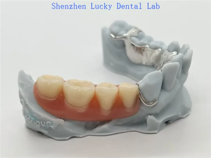 Marco de Metal Co Cr con impresión 3D con dentaduras postizas acrílicas