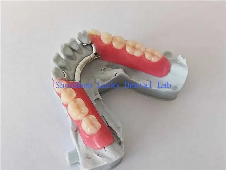 Prueba de dentadura acrílica parcial de impresión 3D con marco de metal intenta en dental laboratorio