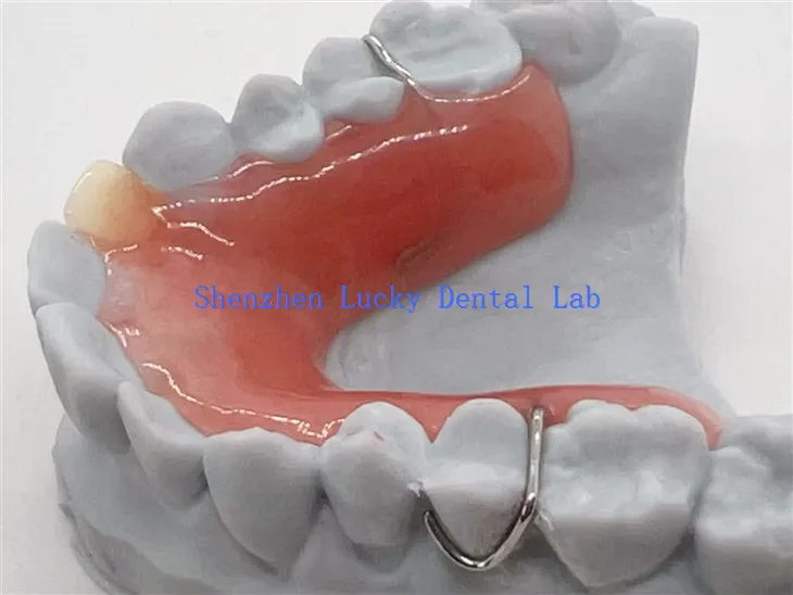 Dentadura postiza parcial removible con impresión 3D y base acrílica