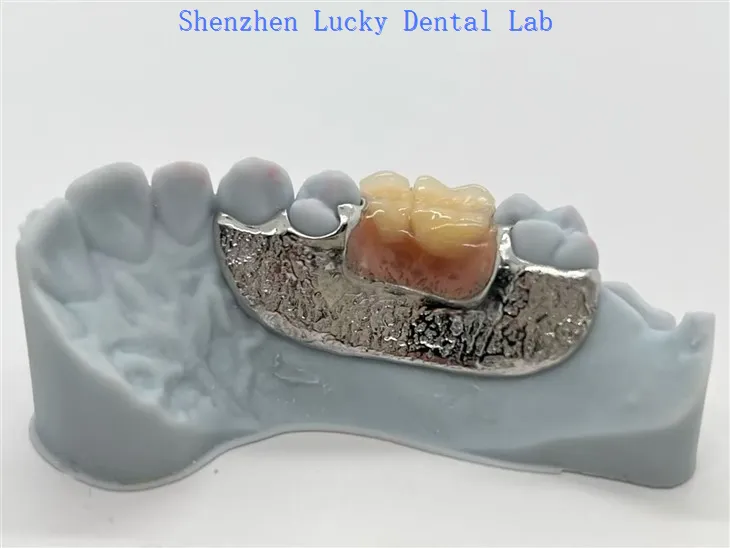 Base metálica para dentadura parcial unilateral con impresión 3D