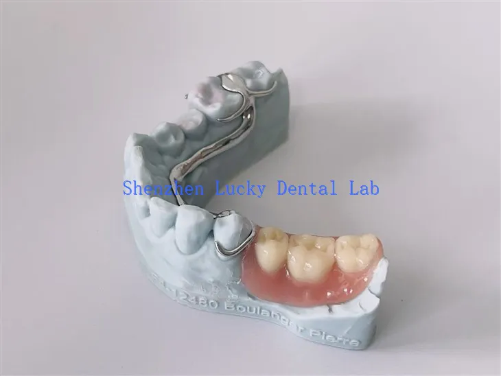 Marco de metal dental de impresión 3D asequible con dentadura acrílica
