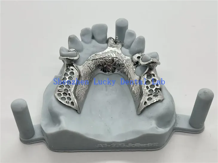 Prótesis parciales con estructura fundida