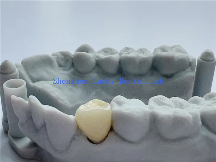 Corona de Zirconia Dental de China Estética Dental