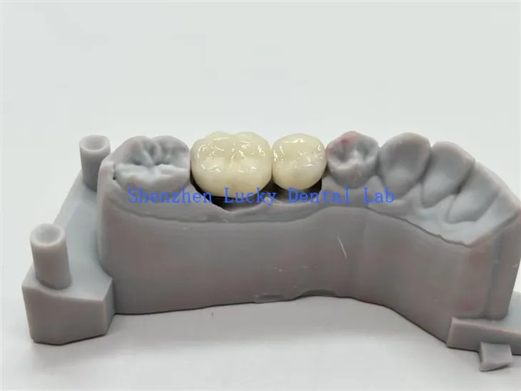 Coronas dentales PFM de aleación de CoCr