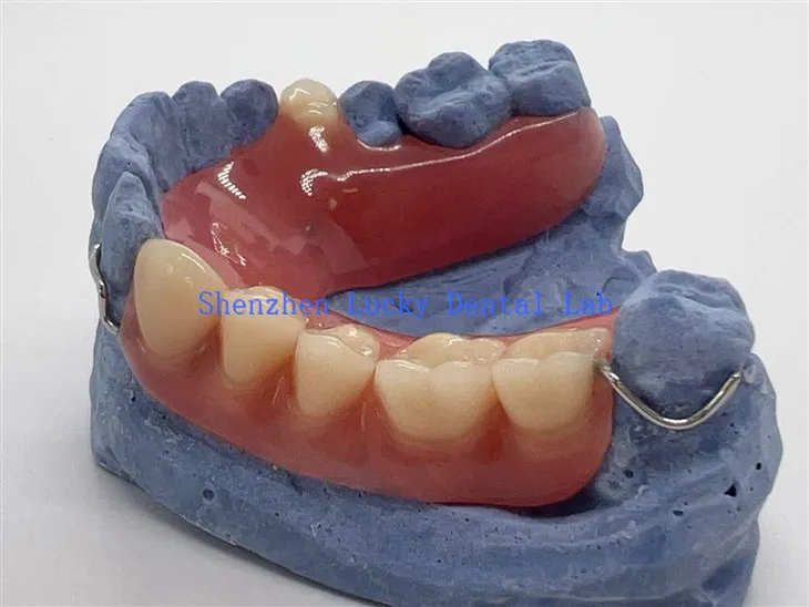 Cómoda dentadura acrílica parcial con broche de alambre