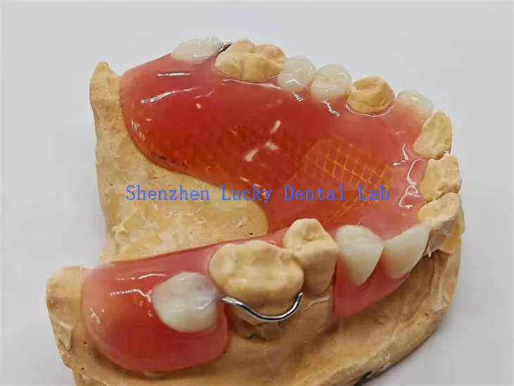 Dentadura postiza parcial extraíble con malla de metal