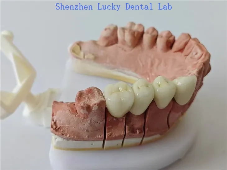 PFM Dental PFM puentes sin margen de metal Laboratorio dental