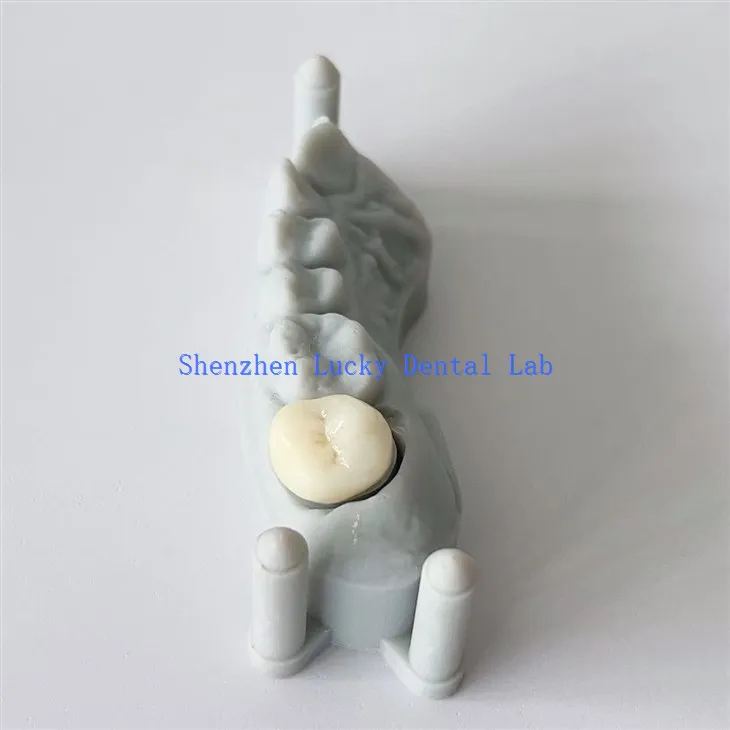 Corona de circonio de circonía de cerámica de impresión 3D de alta calidad