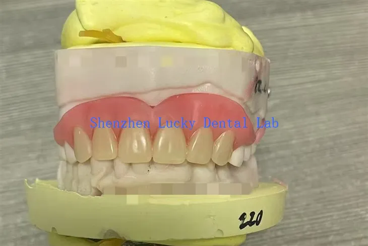 Prueba de dentadura postiza flexible parcial en Dental Lab