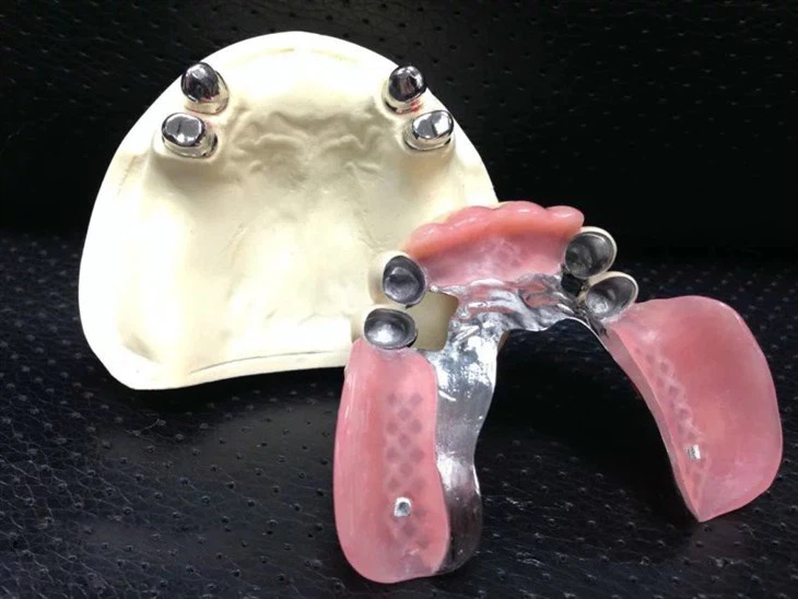 Sobredentadura con fijación de bola natural