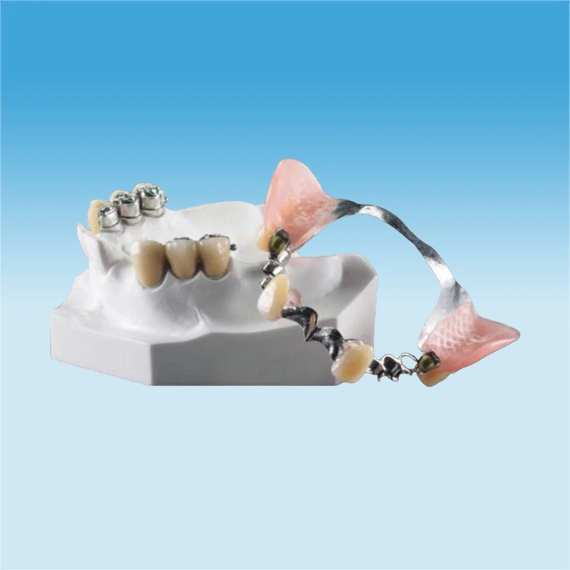 Natural Partial Denture Attachments