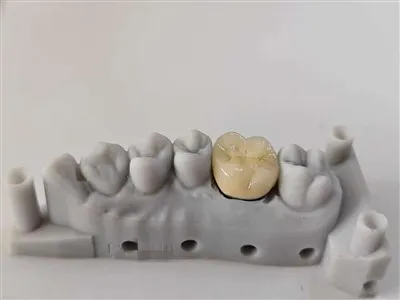 China Dental PFM COCR Crown Factory