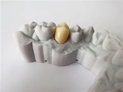 Corona de Zirconia Dental de alta calidad de China